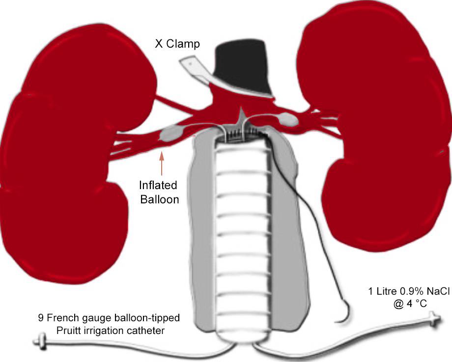 continuous-crystalloid-renal-perfusion-during-open-aaa-repair