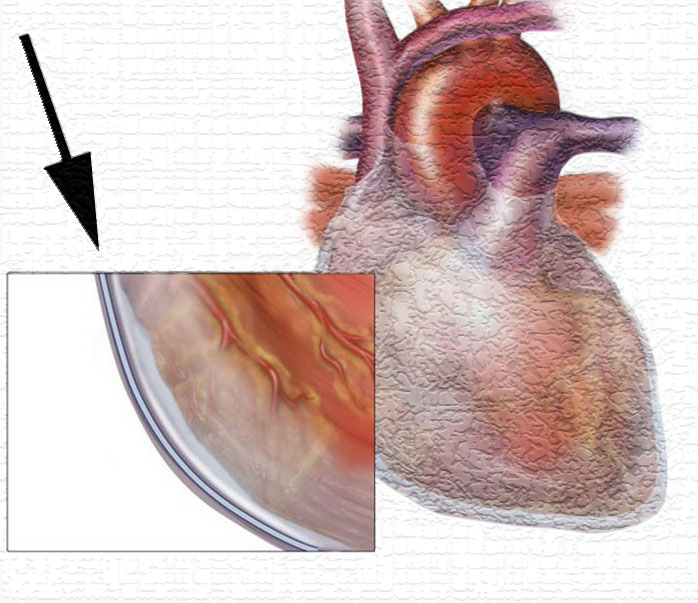 Pericarditis|CC