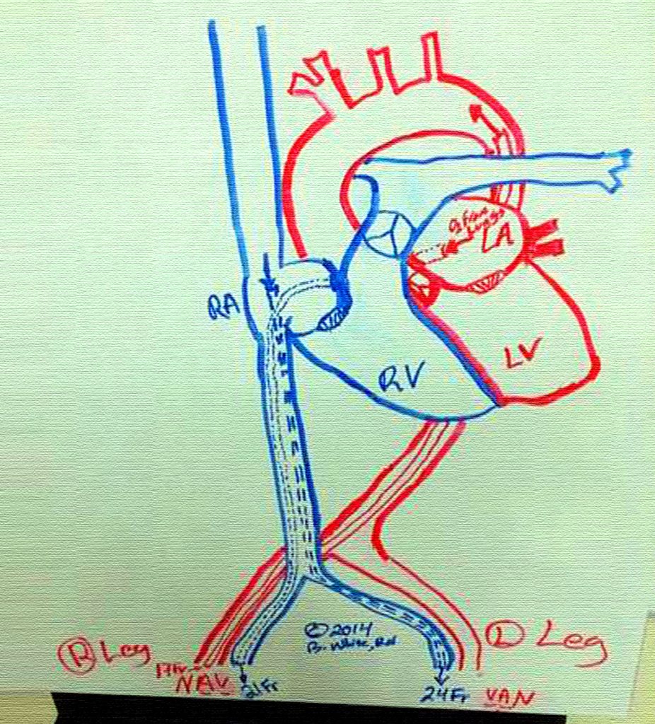 Transeptal RA to LA off load cannula with VA ECMO