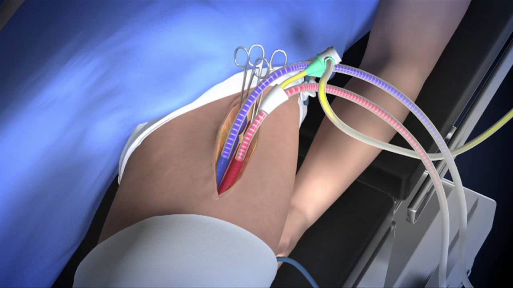 adult ecmo