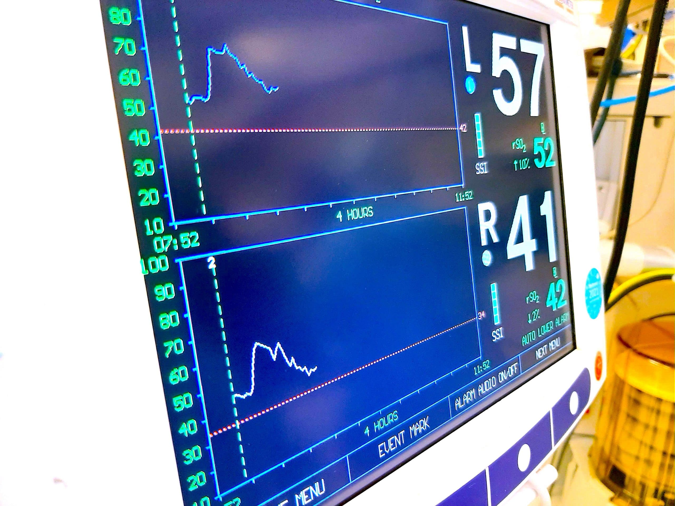 postoperative-delirium-is-a-risk-factor-of-poor-evolution-three-years