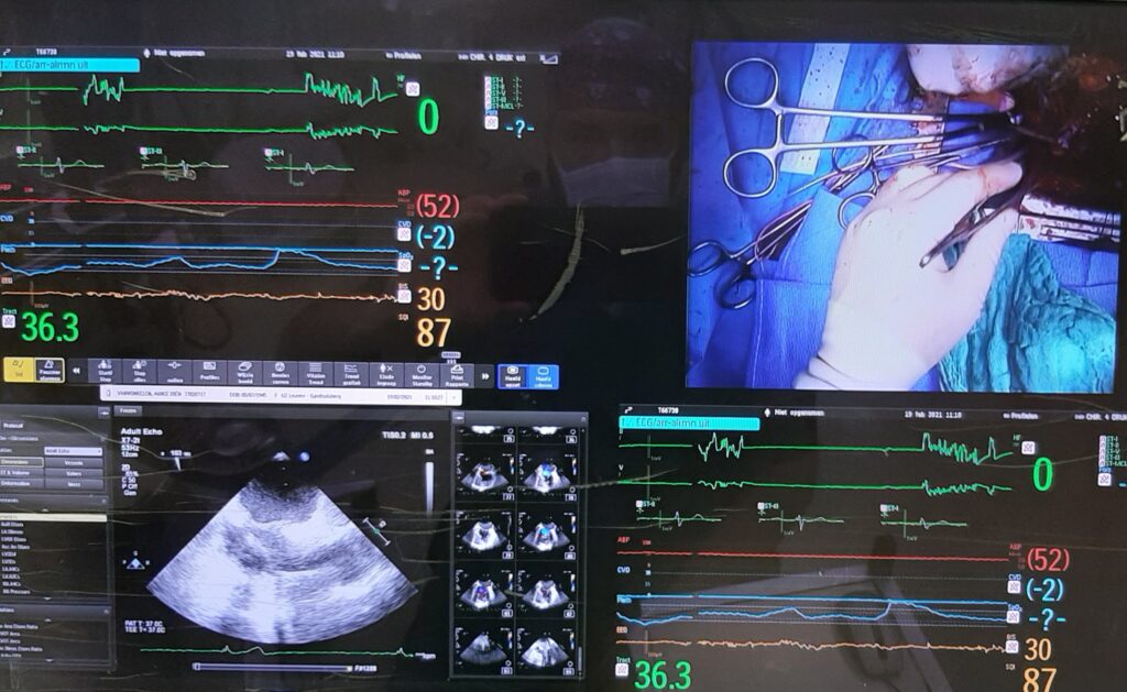 perfusion screen